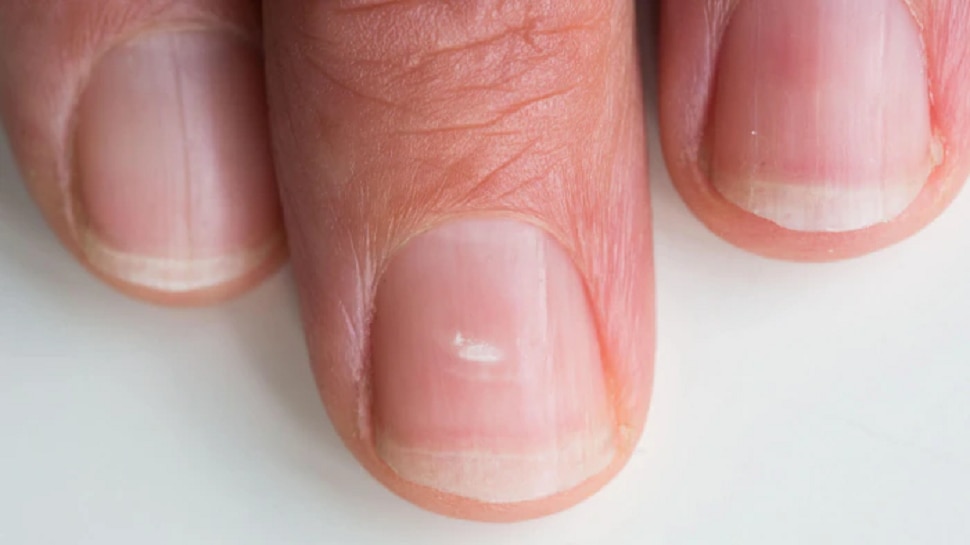 Zinc Deficiency Is The Reason For White Spots On Nails | White Spots On  Nails: మీ గోళ్ల మీద తెల్లటి మచ్చలు ఉన్నాయా? మీలో ఈ సమస్య ఉన్నట్లే!
