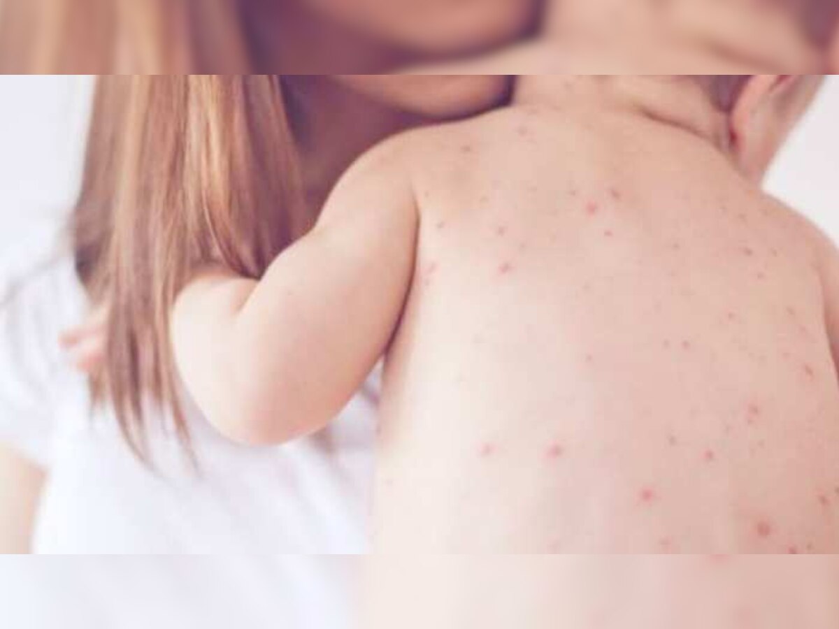 Measles Outbreak in Mumbai: मुंबईत गोवरचं थैमान! सव्वा वर्षाच्या मुलीचा मृत्यू, धक्कादायक माहिती समोर title=