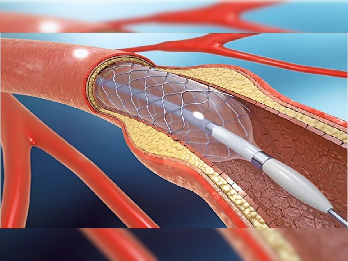 हार्ट ऑपरेशन स्वस्त होणार; हृदयविकार रुग्णांसाठी जीवरक्षक ठरणाऱ्या स्टेंटचा औषधांच्या यादीत समावेश  title=