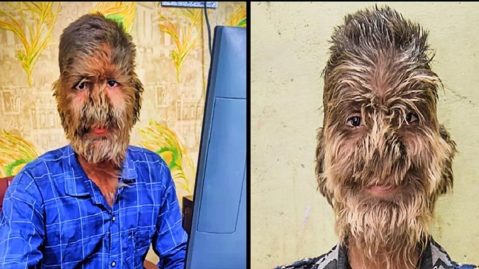 hypertrichosis syndrom Boy with rare werewolf has hair growing all over