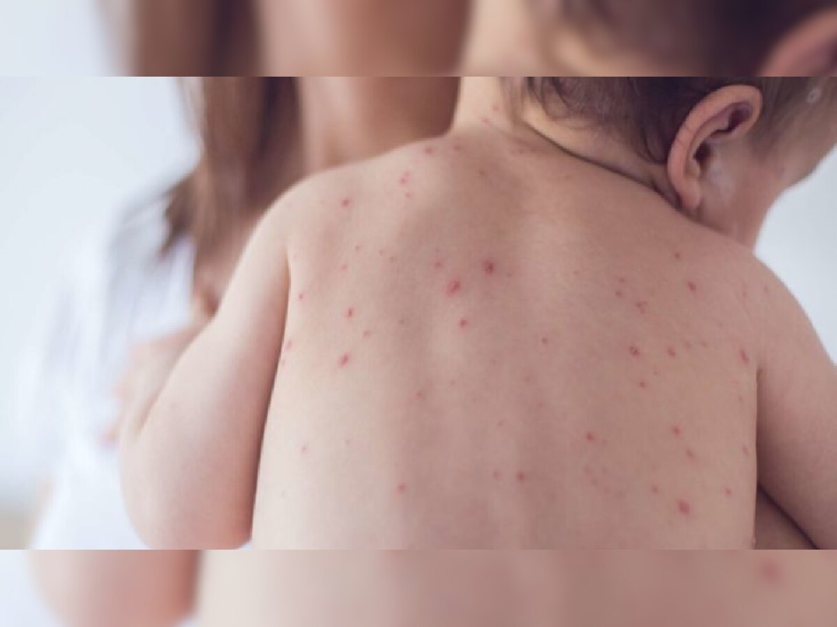 Measles Outbreak : गोवरचा आणखी एक बळी; गोवंडीत 8 महिन्यांच्या मुलाचा मृत्यू title=