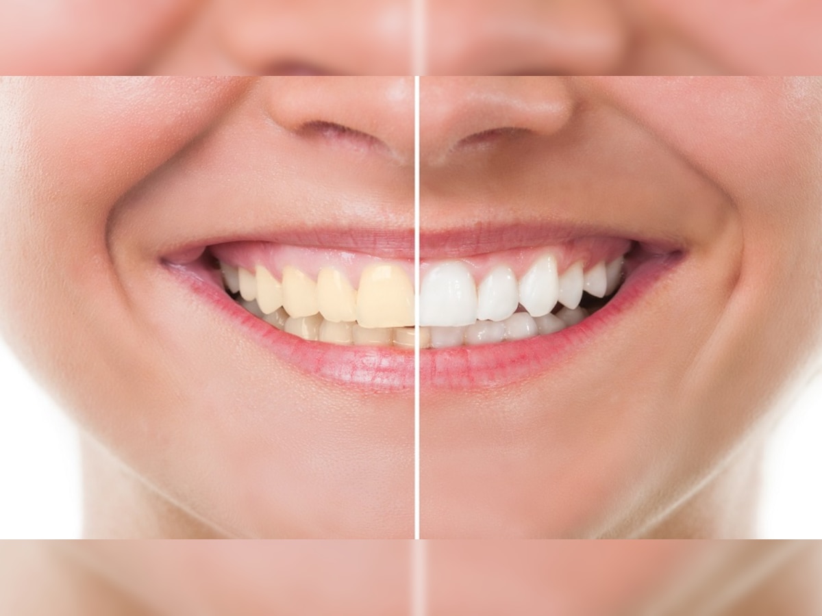 Teeth Whitening : पिवळे दात होतील चकाचक, 'या' घरगूती टीप्स वापरून पाहा   title=