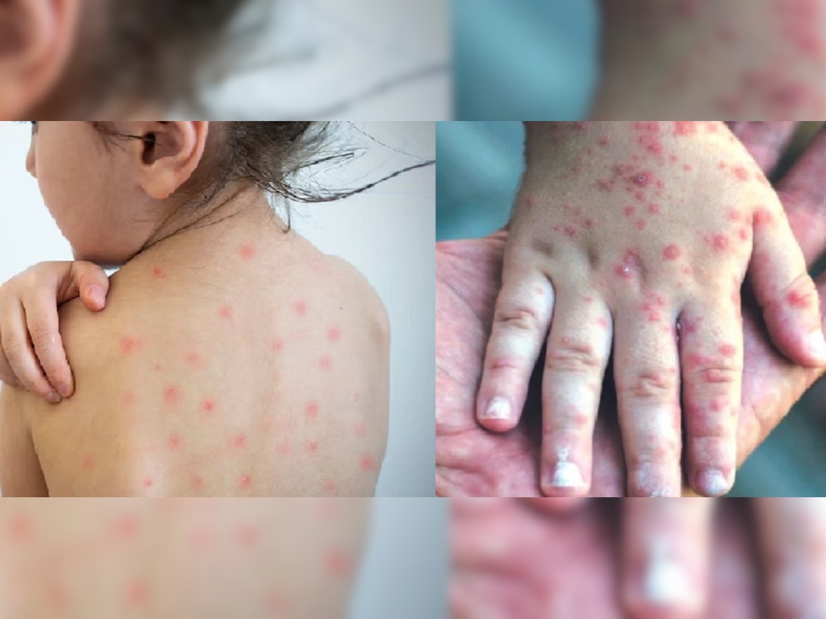 Measles Outbreak : राज्यात 34 ठिकाणी गोवरचा उद्रेक, कोरोनापेक्षा पाच पट वेगाने पसरतोय title=