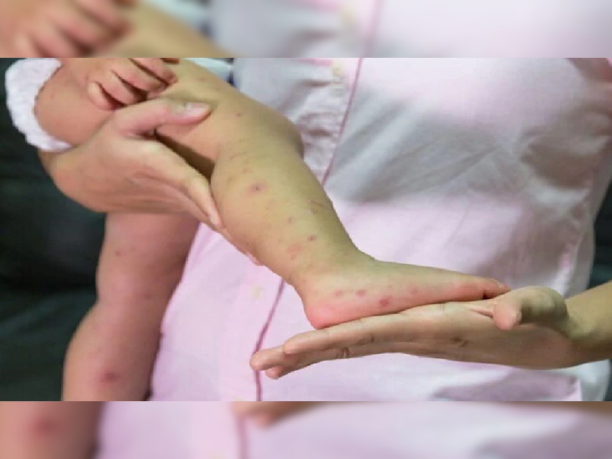 Measles : गोवरचा कोरोनापेक्षा पाचपट वेगानं फैलाव? title=
