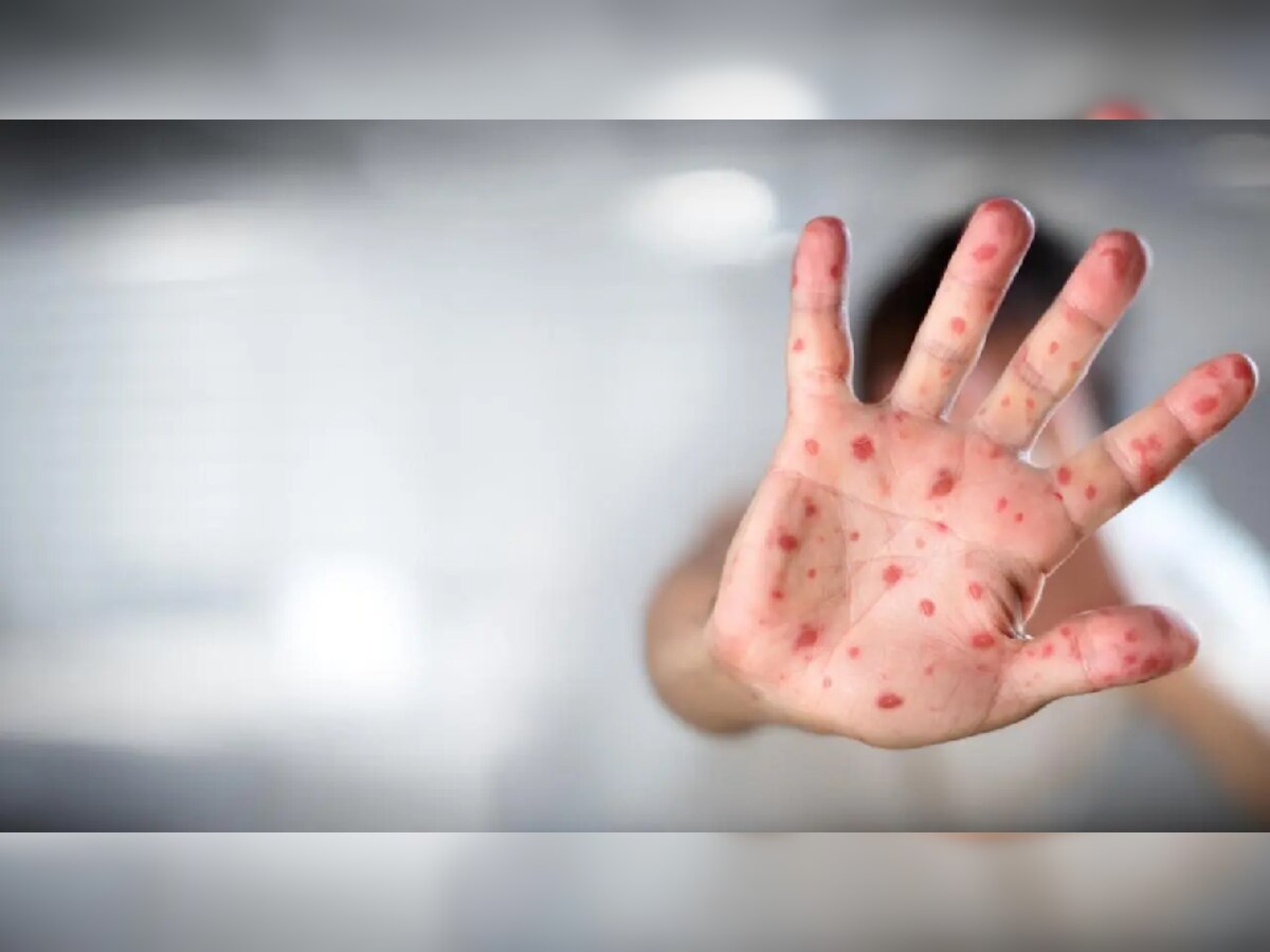 Measles Outbreak: गोवरचा प्रसार रोखण्यासाठी राज्य सरकार लागलं कामाला, असा आहे Action Plan title=