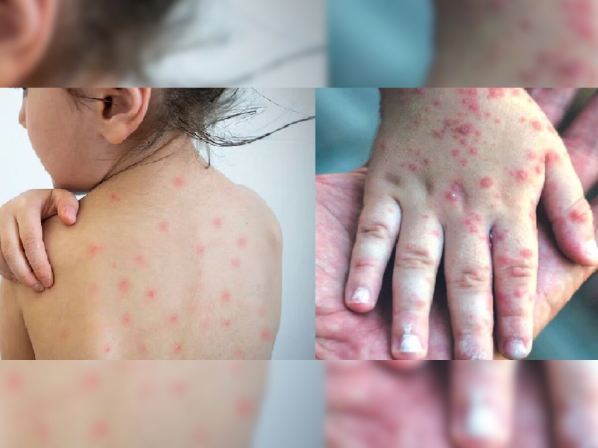 Measles Outbreak : राज्यात गोवरचा उद्रेक, रुग्णांची संख्या 12 हजारांपार title=