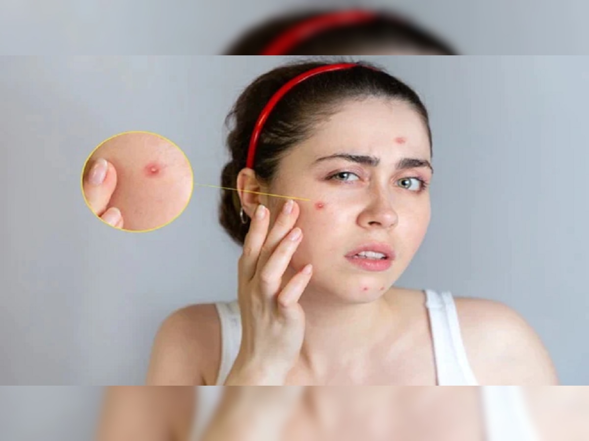 pimples: या गोष्टींमुळे येतात चेहऱ्यावर पिंपल्स...अजिबात खाऊ नका... title=