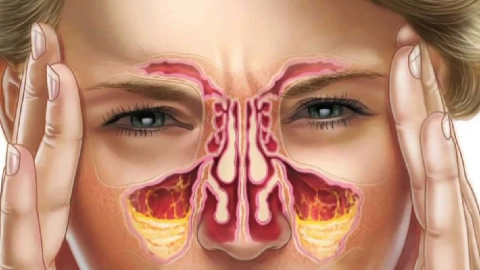 sinuses infection