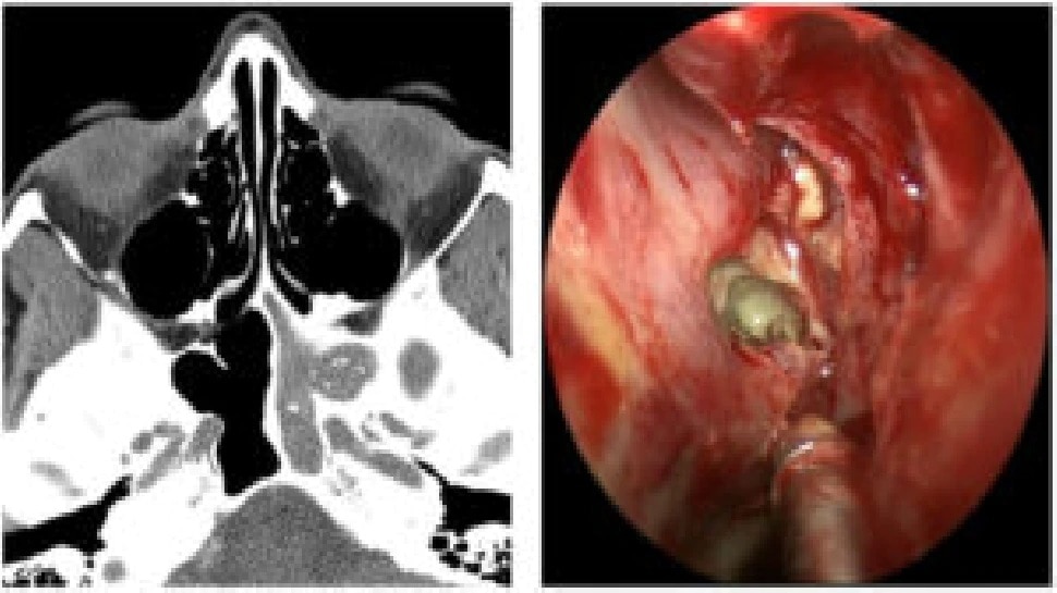 sinuses infection