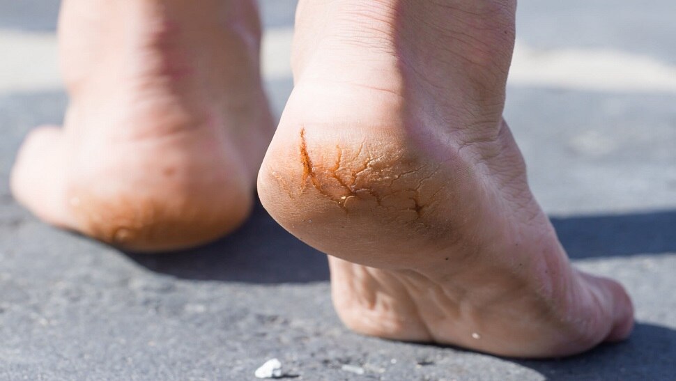 Cracked Heels : टांचाना पडलेल्या भेगांमुळे त्रस्त आहात, हे घरगूती उपाय करून बघा 