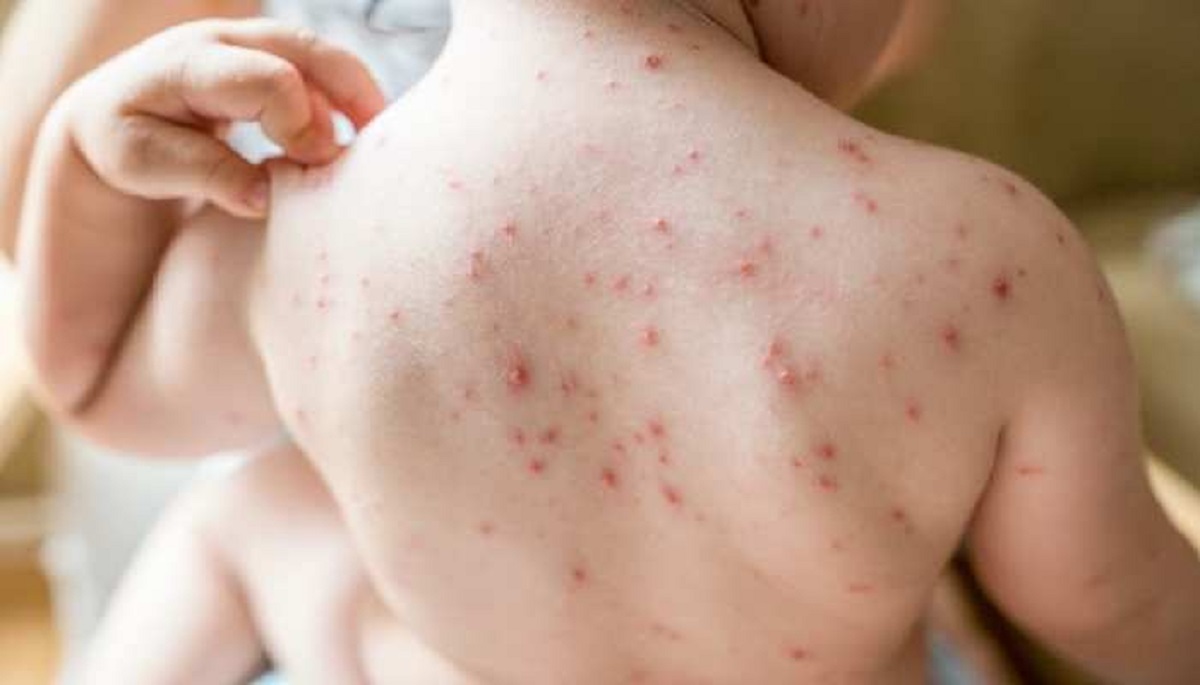 Measles Outbreak in Mumbai , A little girl died of measles in Kurla GS