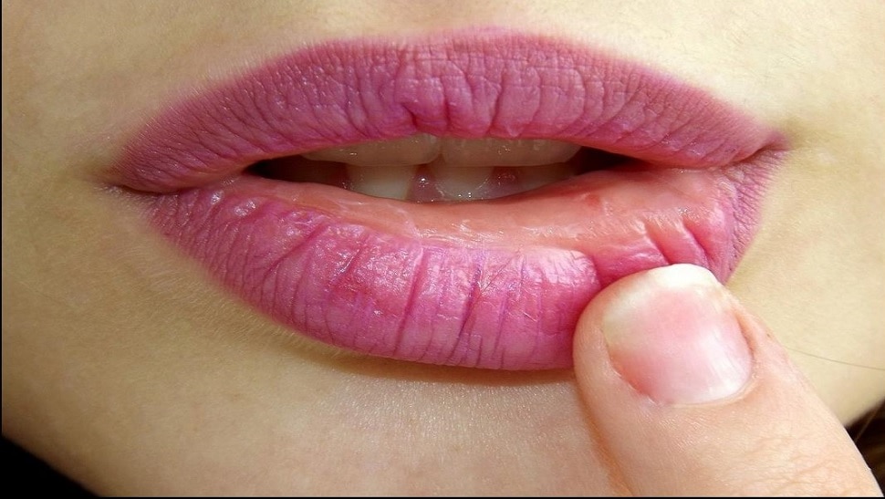 cracked lips home remedies health care tips health ness alovera jai ...