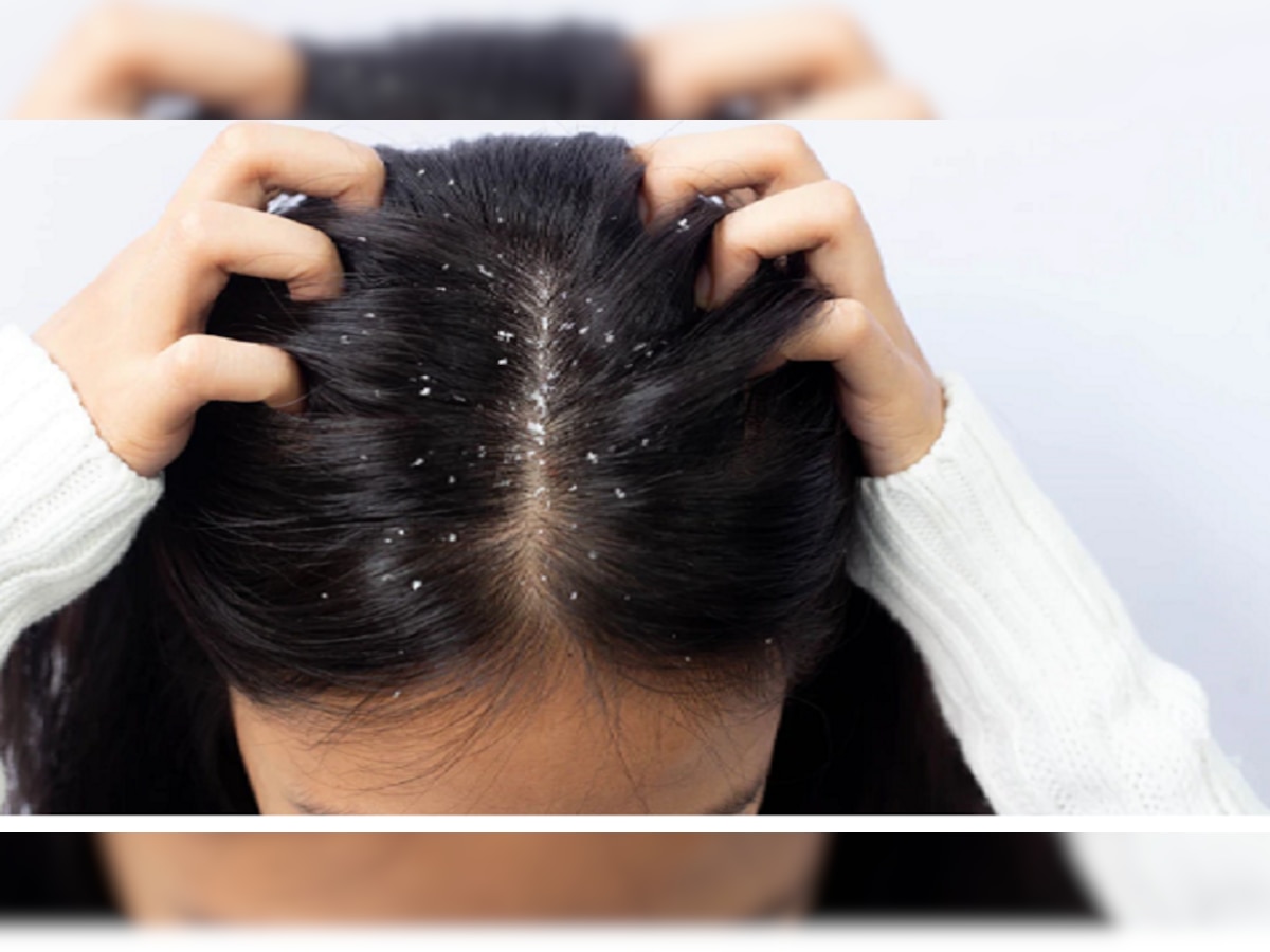 dandruff treatment : डोक्यात कोंडा झालाय खाज सुटलीये? हा उपाय एका आठवड्यात करेल काम...एकदा करून पाहाच title=