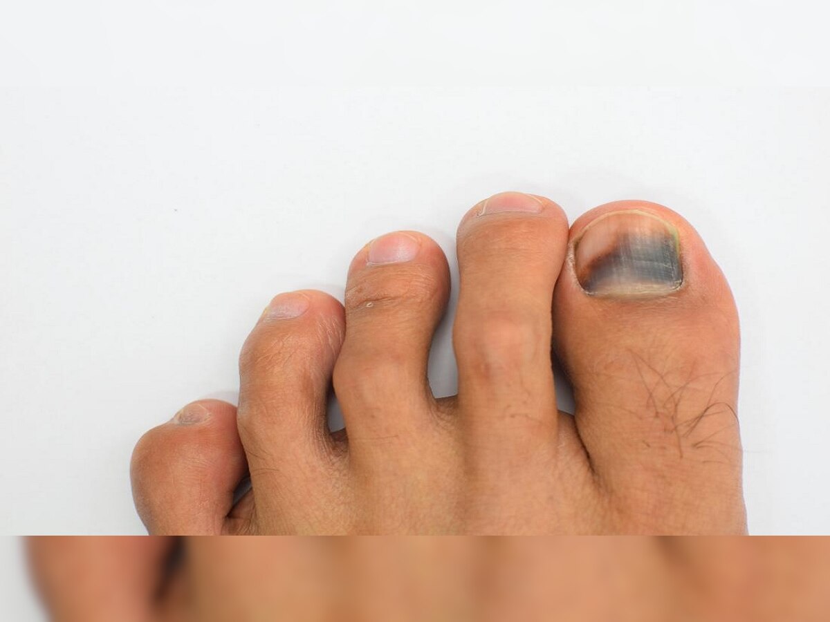Black toe nail: पायांची नखं काळी पडताहेत का? असू शकतात गंभीर आजाराची लक्षणं...वेळीच व्हा सावध ! title=