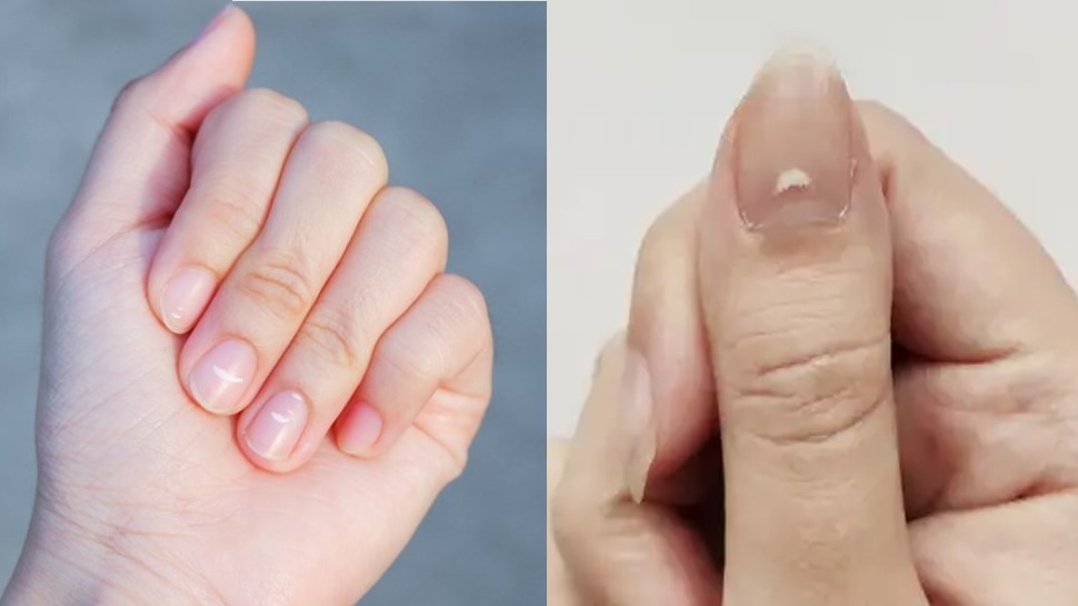 What Is Meaning Of White Spot On Nails