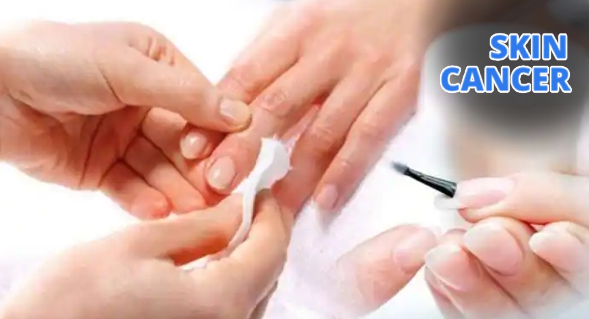 US woman develops cancer after nail technician goes too rough In manicure Alert महिलांनो