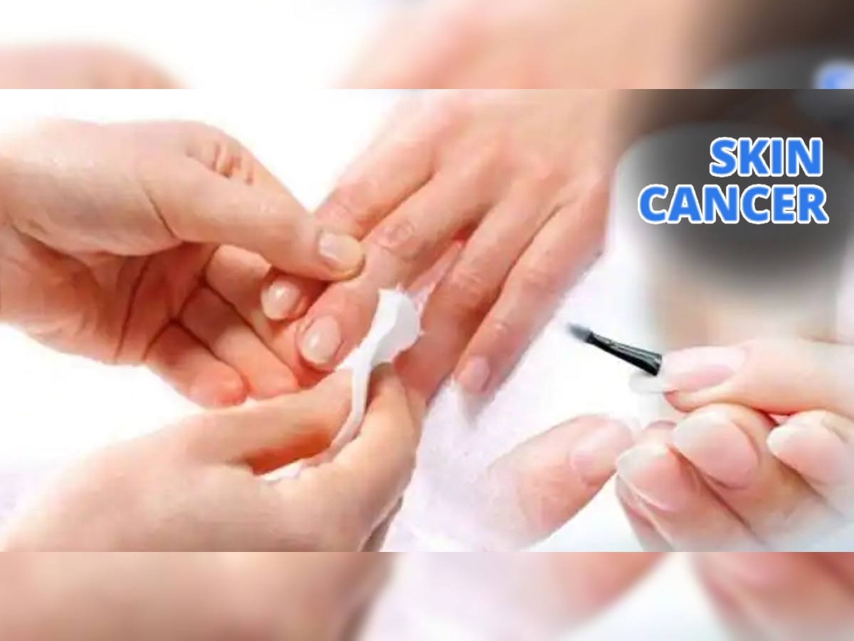 Cancer Infection Manicure: नखांचं सौंदर्य वाढवण्यासाठी केलेल्या मॅनीक्युअरमुळे झाला कॅन्सर; डॉक्टरांनी सांगितलं नेमकं कारण title=