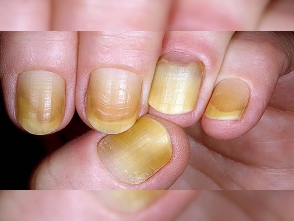 Yellow Nails : हाताची नखं झालीत पिवळी 'हे' घरगुती उपाय वापरल्यास नक्कीच होईल फायदा title=