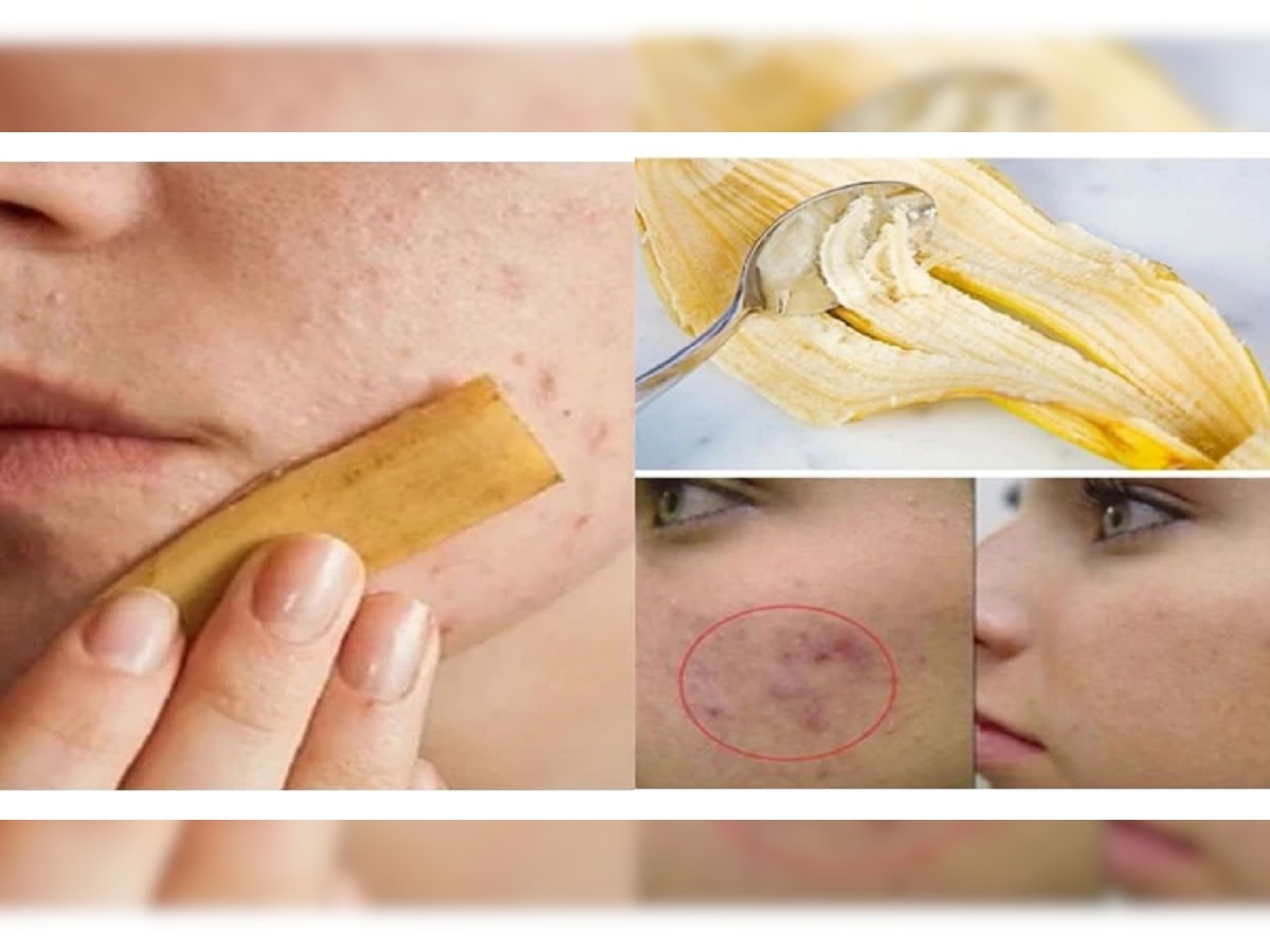Pimple Remedies: एका रात्रीत चेहऱ्यावरचे पिंपल्स घालवायचे आहेत? हे घरगुती उपचार ठरतील रामबाण... title=