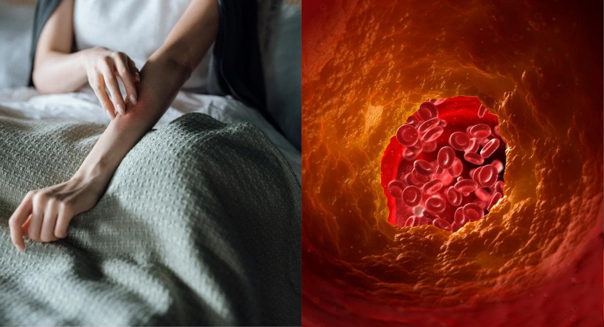 High cholesterol Signs of increased cholesterol can also be seen in