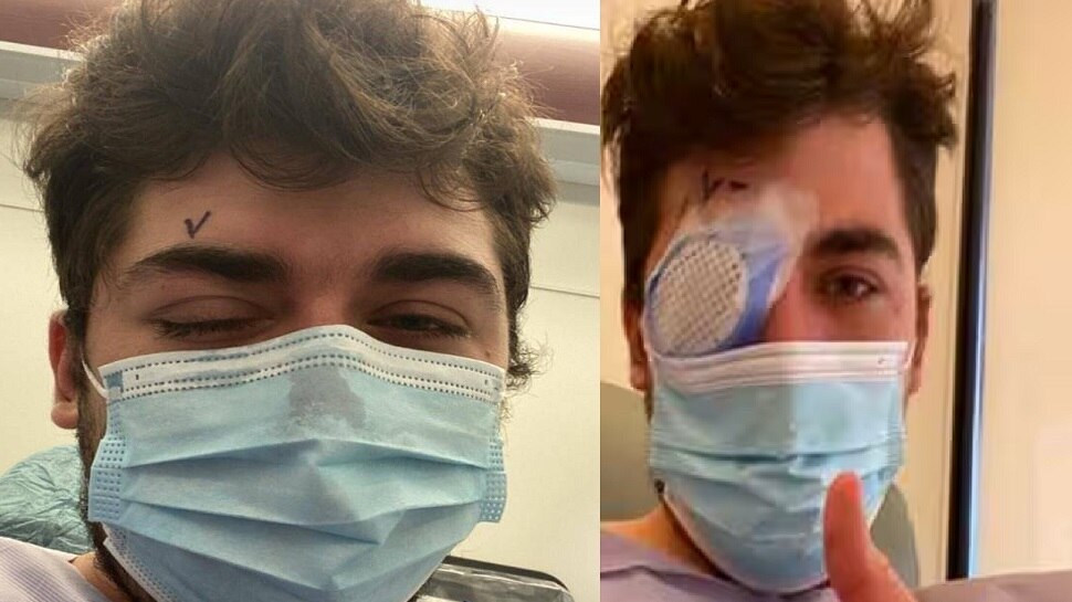 viral news a man sleeps with contact lens parasites started eating his