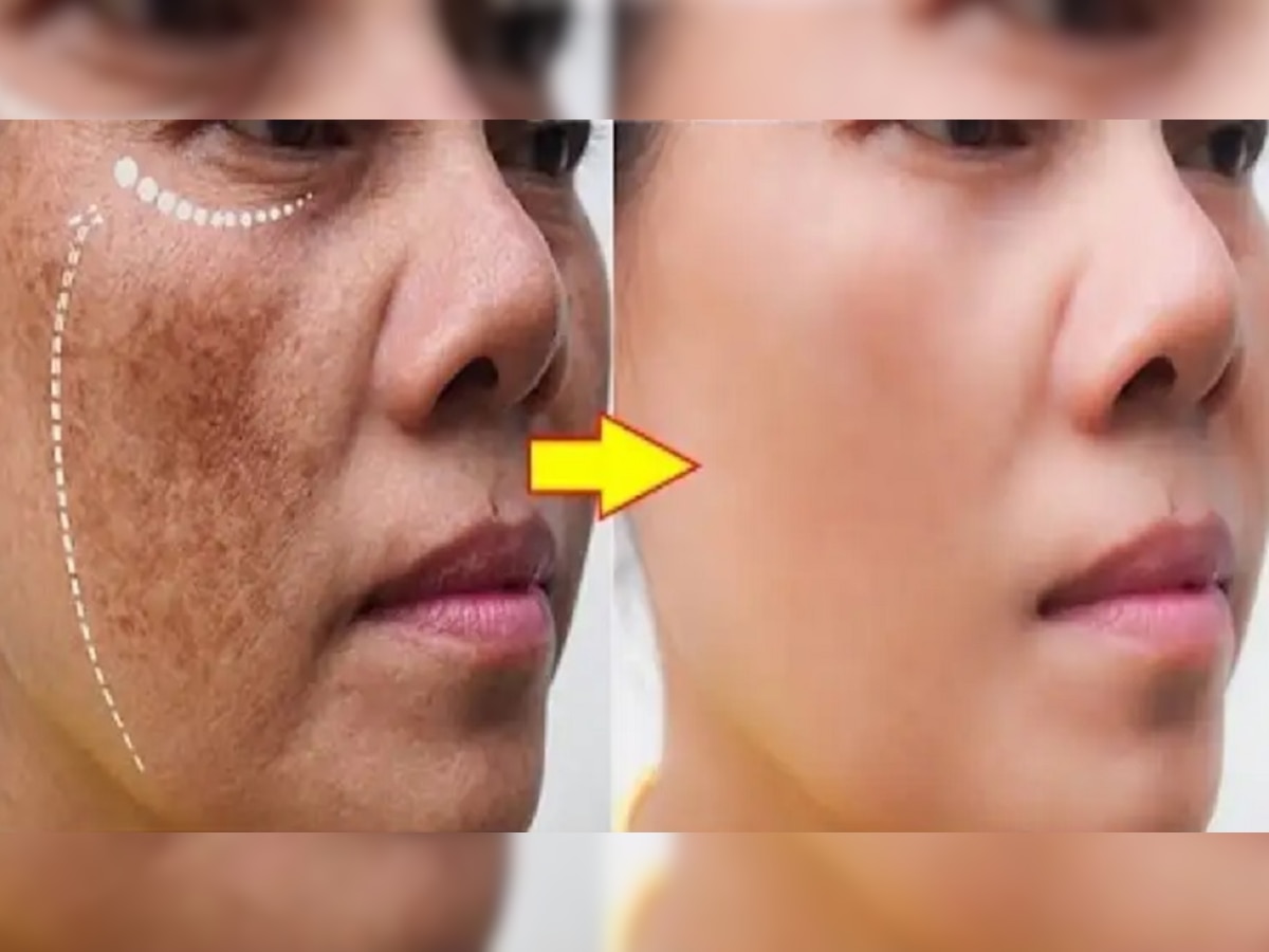 Skincare : चेहऱ्यावर वांग का पडतात ? वांग घालवण्याचे सोप्पे उपाय जाणून घ्या  title=