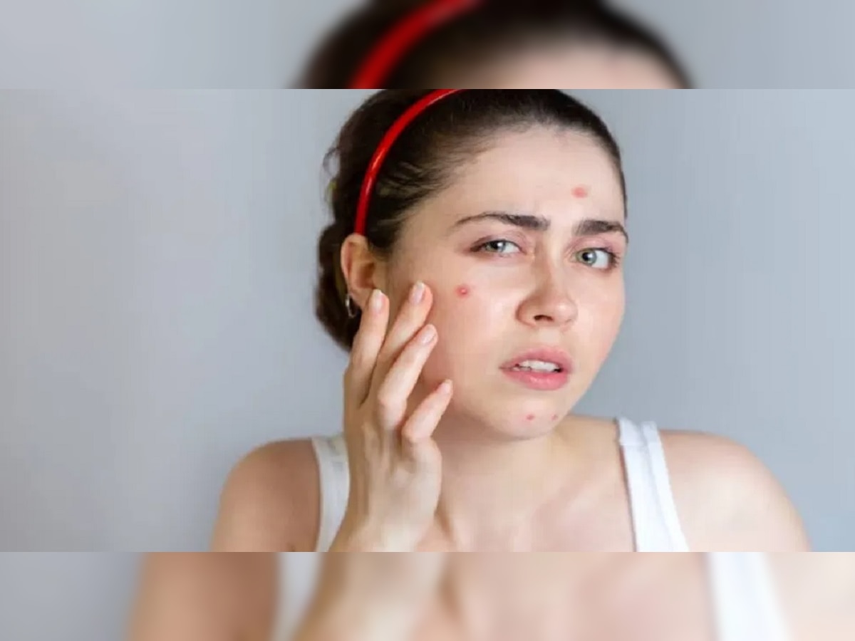 Pimples Removing Tips: चेहऱ्यावरील पिंपल्स आणि काळ्या डागांमुळे आहेत त्रस्त? मग आजच करा हे घरगुती उपाय.. title=