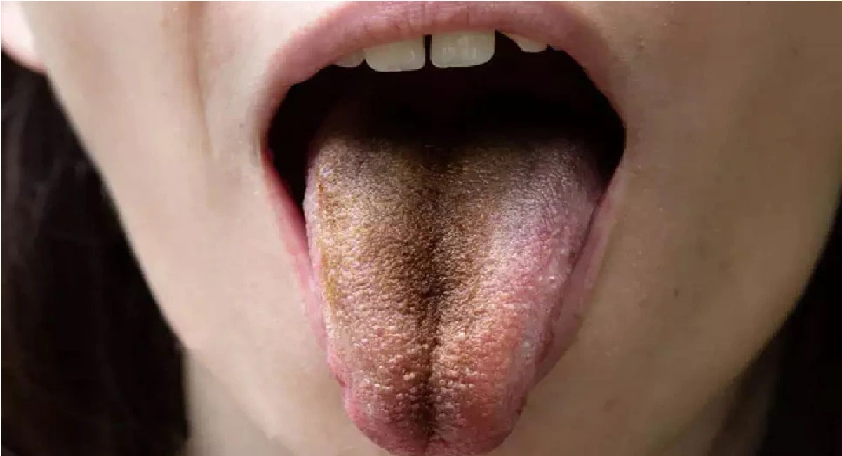 black tongue