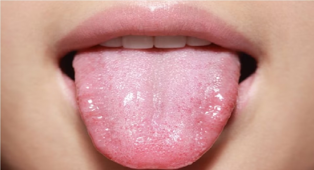 white tongue