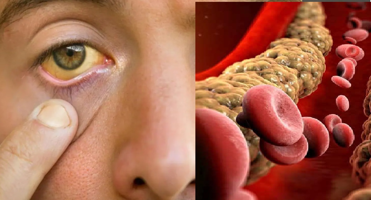 high-cholesterol-symptoms-in-eyes-3-symptoms-of-increasing-bad