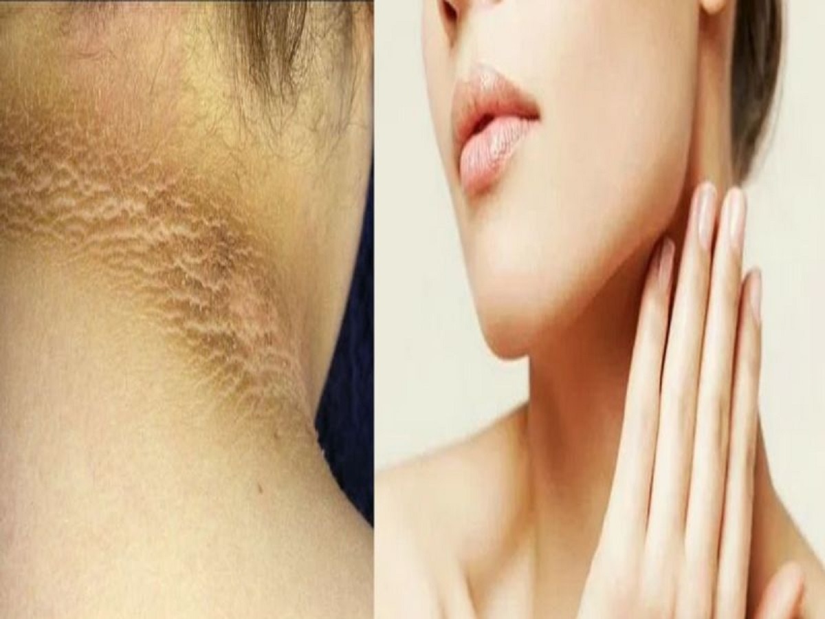 Neck Skin Tips : काळ्या पडलेल्या मानेवर 'हे' घरगुती उपाय करा, त्वचा होईल स्वच्छ व सुंदर!  title=