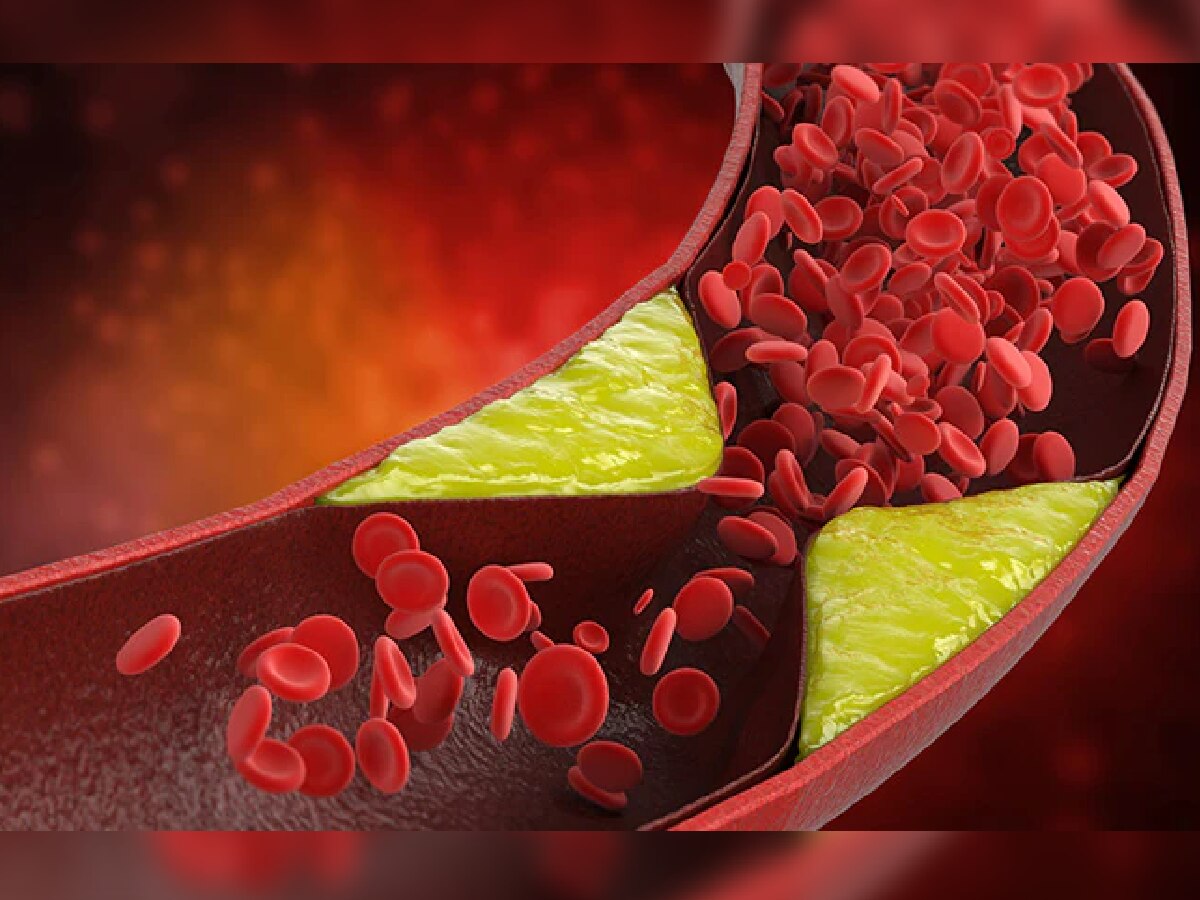 High Cholesterol : 'हे' पदार्थ रक्तातील खराब कोलेस्टेरॉल दूर करण्यासाठी ठरतील फायदेशीर title=