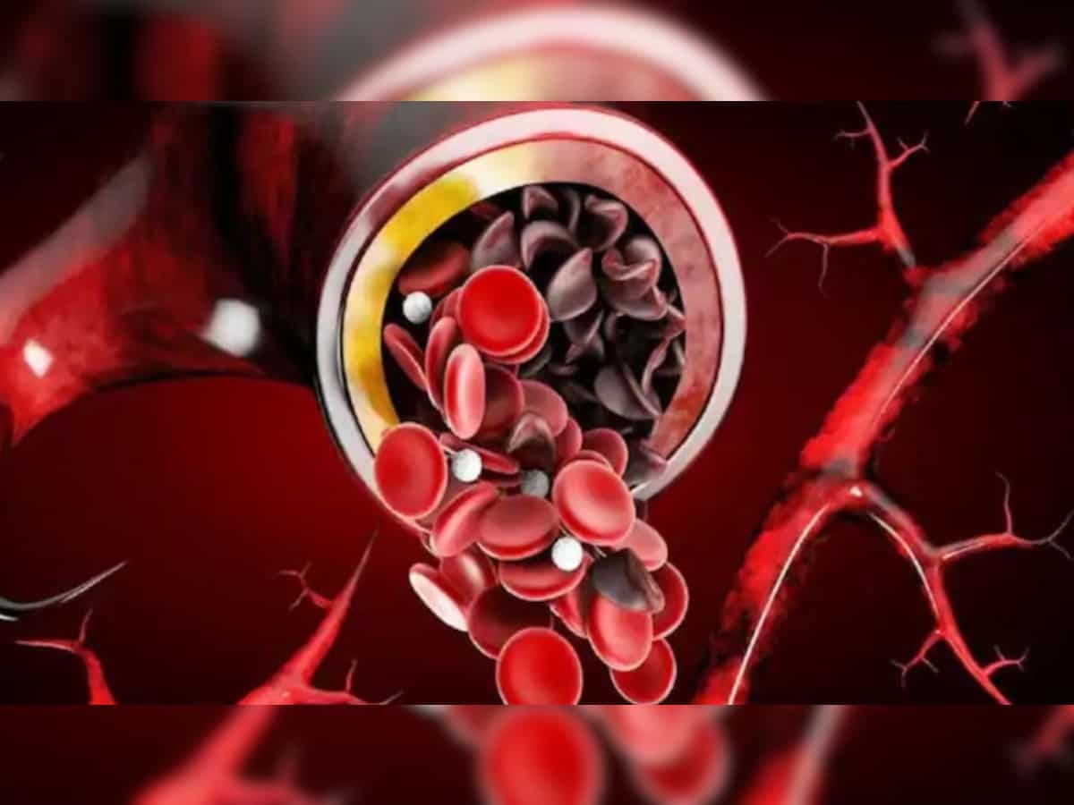 Sickle Cell Anemia: 7 कोटी नागरिक सिकलसेल अ‍ॅनिमियाचे रुग्ण; लक्षणे, उपचार जाणून घ्या  title=