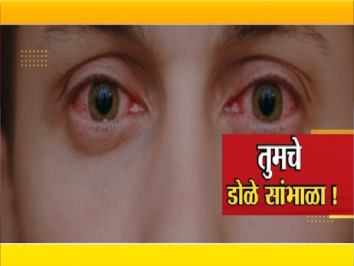 तुमचे डोळे लाल तर झाले नाहीत ना! देशात Eye Flu संकट...पाहा काय काळजी घ्याल title=