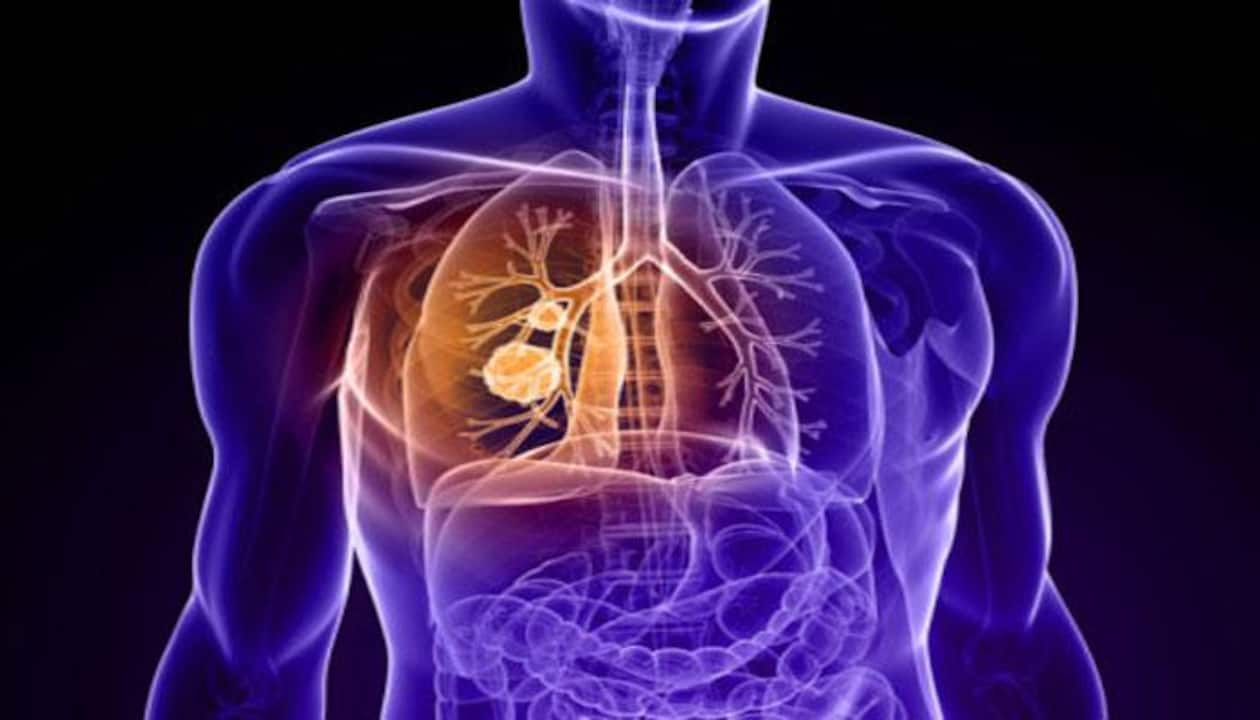 World Lung Cancer Day rise even among non smokers know Reasons symptoms