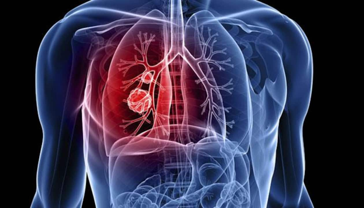 World Lung Cancer Day rise even among non smokers know Reasons symptoms 