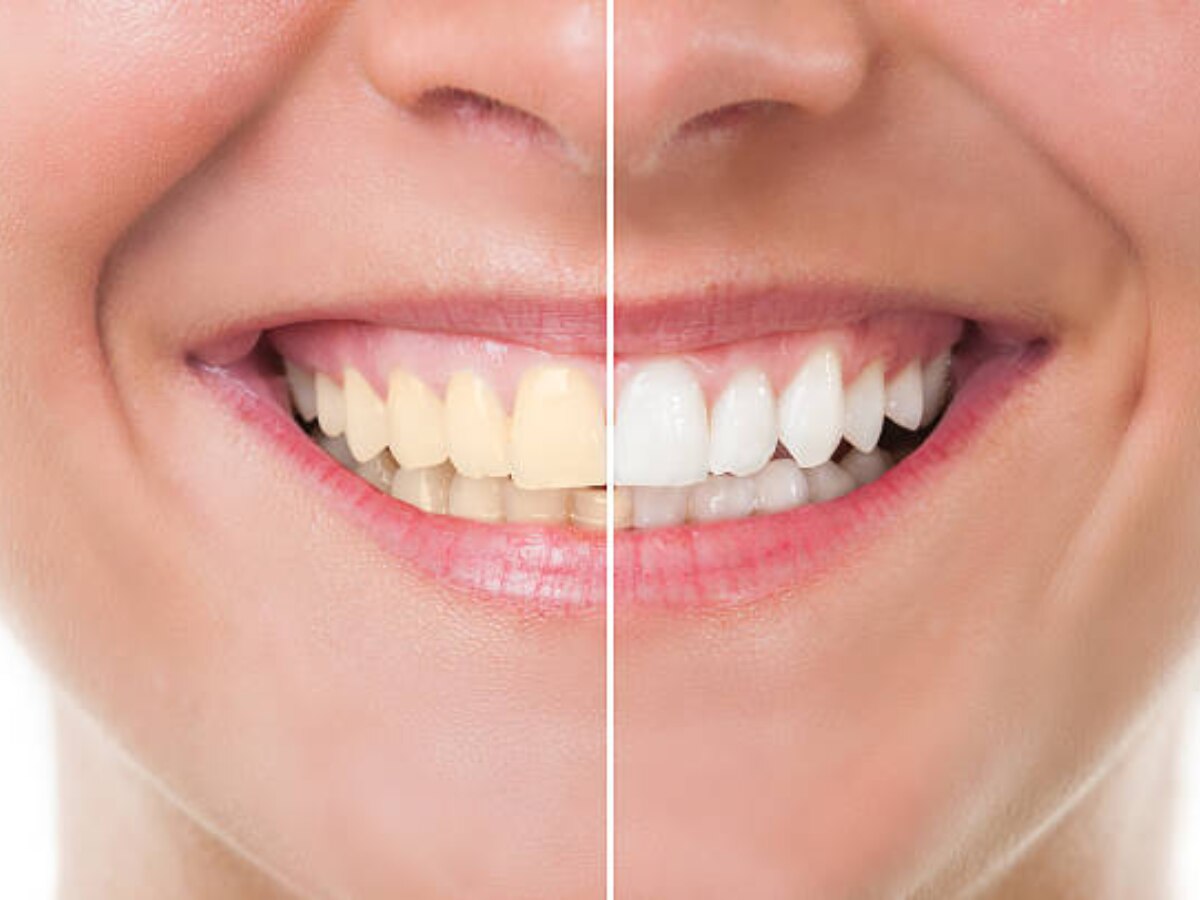 दातांवरचा पिवळा थर 6 आयुर्वेदिक उपायांनी होईल साफ, मोत्यासारखे चमकतील दात title=
