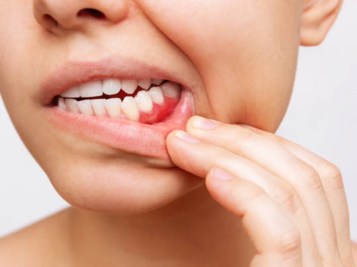 तोंडातील 'या' भागांच दुखणं म्हणजे Mouth Cancer चे लक्षणं, दातदुखीकडेपण करू नका दुर्लक्ष title=