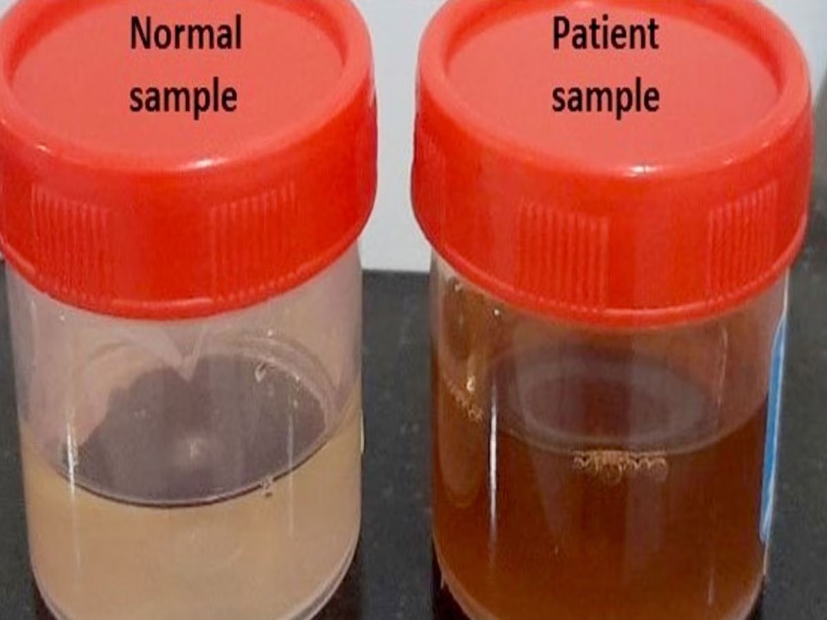 Urine or Pee Colors Indicate Health Issue Know 6 Colour Urine Cause And Affects 