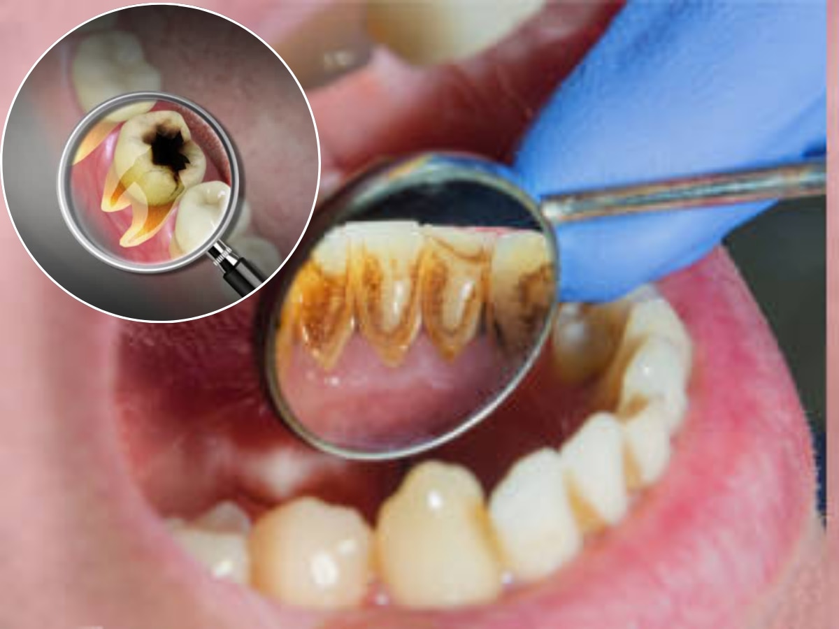 दातांना किड लागल्यामुळे निकामी झालेत दात, टीथ कॅविटीवर रामबाण आहे घरगुती उपाय  title=