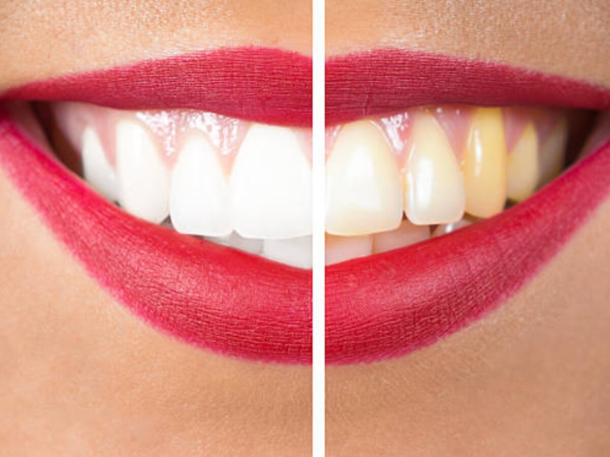 Bay Leaf or Tejpatta Benefits get rid of Yellow Teeth in Marathi