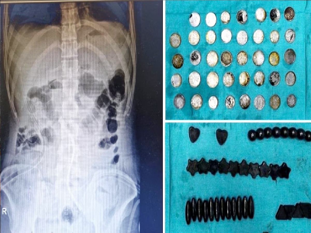 बॉडी बनवण्याच्या नादात तरुणाने गिळले 39 कॉईन आणि 37 लोहचुंबक, कारण काय तर त्यात... title=