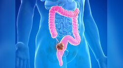 Colon cancer: शरीरात 'हे' बदल दिसली तर वेळीच व्हा सावध; आतड्यांचा कॅन्सरची लक्षणं पाहा