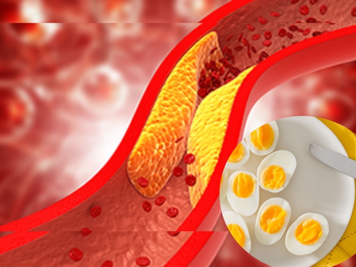 High cholesterol 