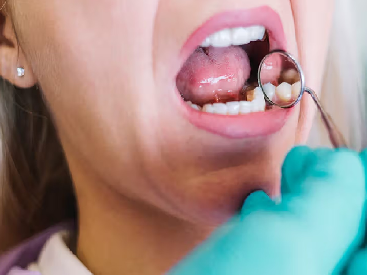 Oral Cancer: तोंडाच्या कर्करोगाशी संबंधित कोणत्या गैरसमजूती मनात असतात? जाणून घ्या title=