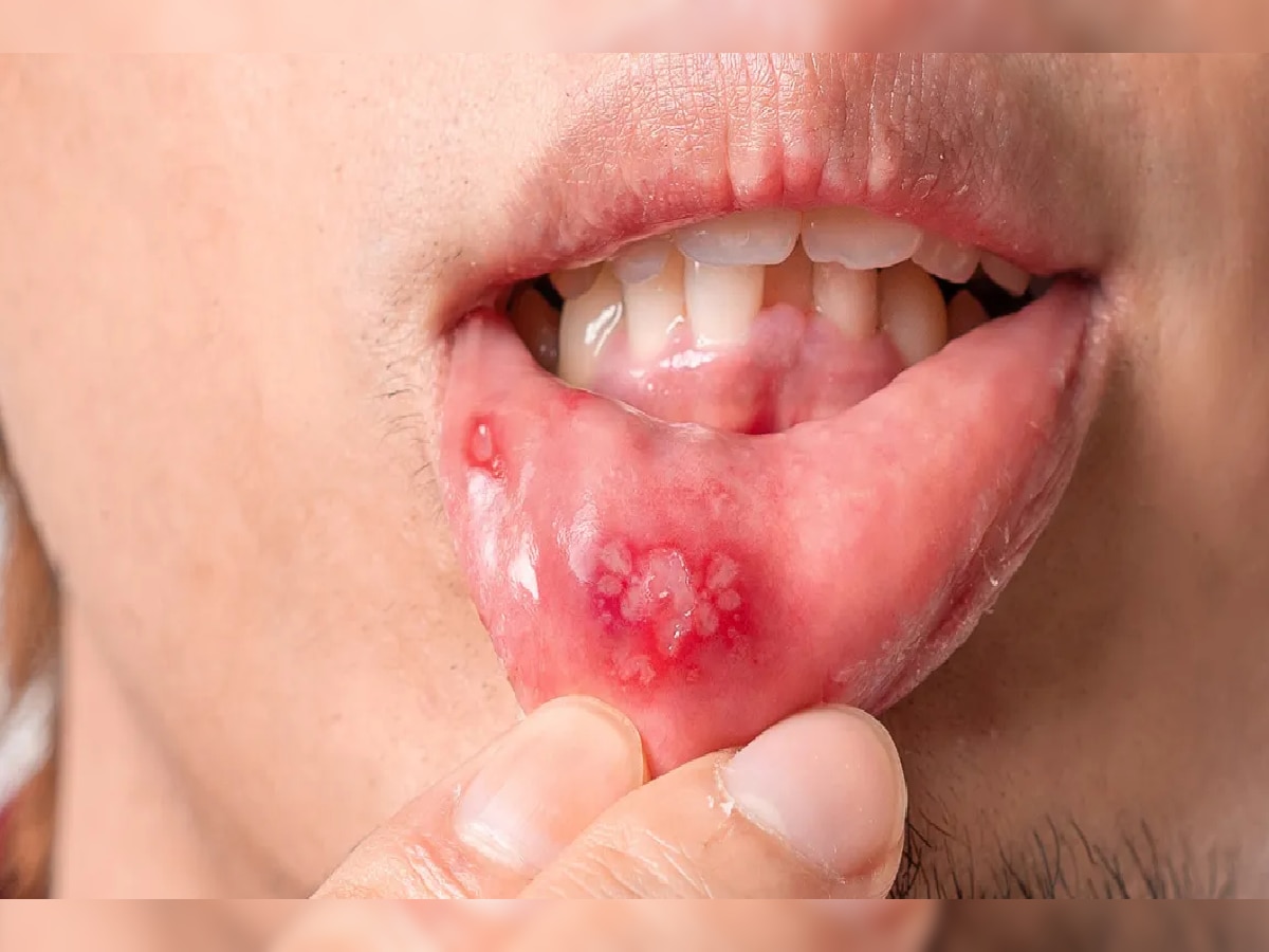 White Blister Risk : वारंवार तोंडाला फोड येणं हे गंभीर आजाराचं लक्षण, 'या' कारणांमुळे येतं तोंड  title=