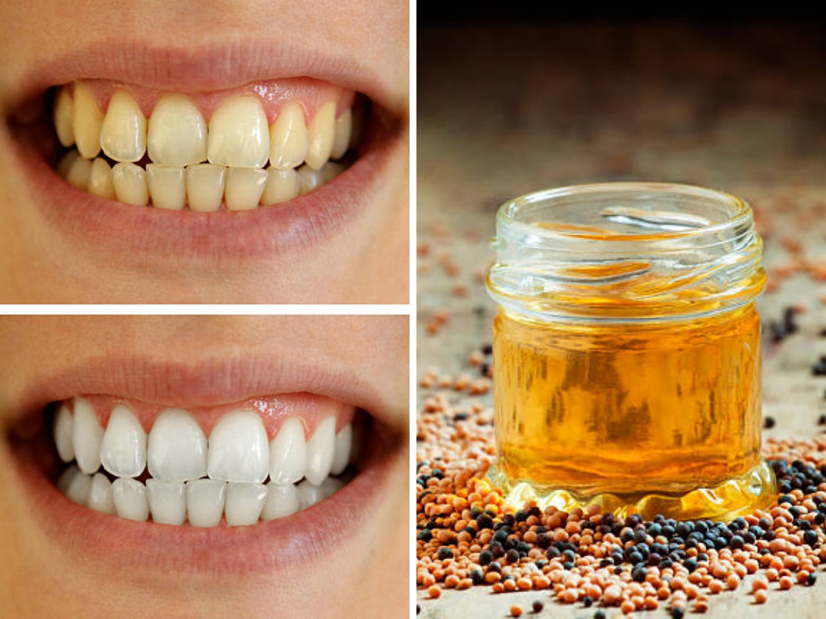 7 Home Remedies for Teeth Whitening Get Rid of Yellow Teeth; स्मोकिंग