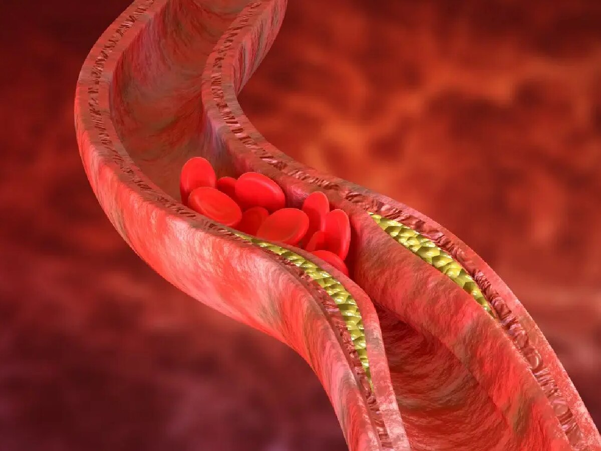 High cholesterol: कोलेस्ट्रॉल वाढल्यानंतर शरीरात लगेच दिसतात 'हे' बदल; वेळीच लक्ष द्या अन्यथा...! title=