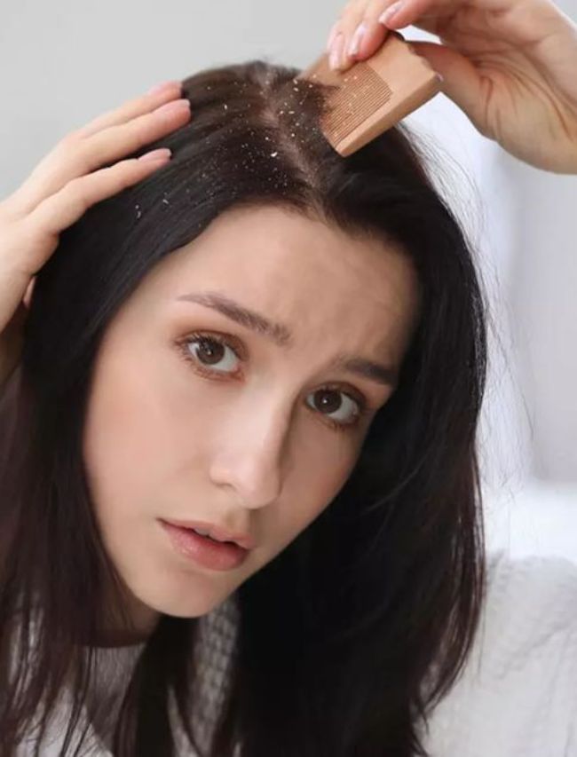 Use these home remedies to get rid of dandruff
