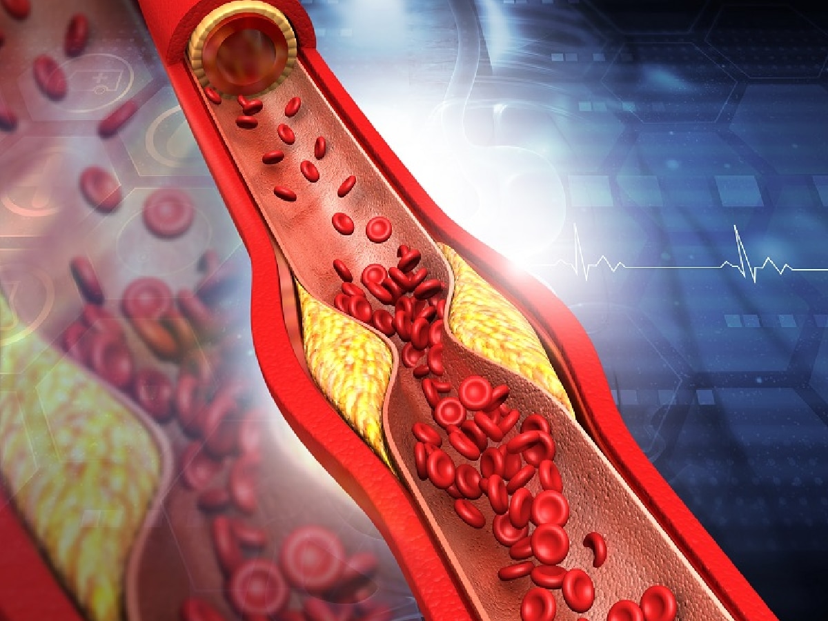 Symptoms of Blocked Arteries: धमन्यांमध्ये ब्लॉकेज असतील तर दिसून येतील 'ही' लक्षणं; सामान्य गोष्ट समजून दुर्लक्ष करू नका! title=